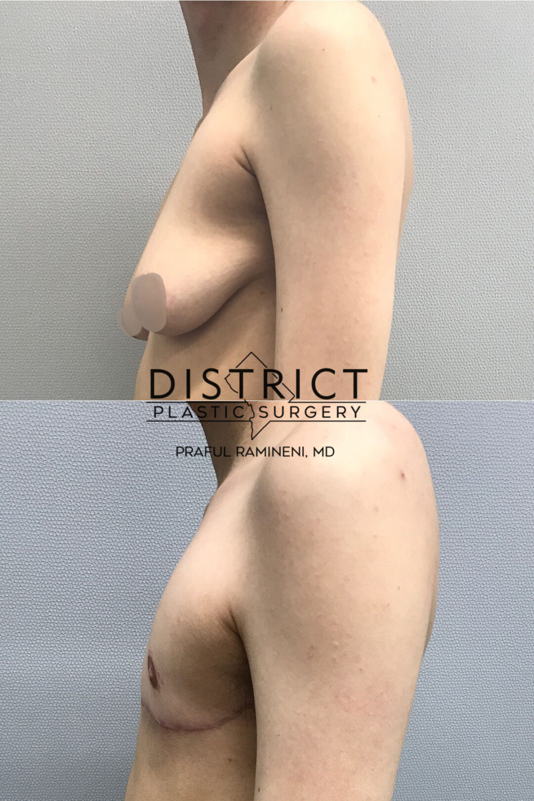 Double Incision Mastectomy Before and After Photo by District Plastic Surgery in Washington, DC