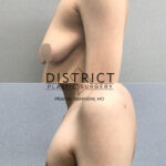 Double Incision Mastectomy Before and After Photo by District Plastic Surgery in Washington, DC