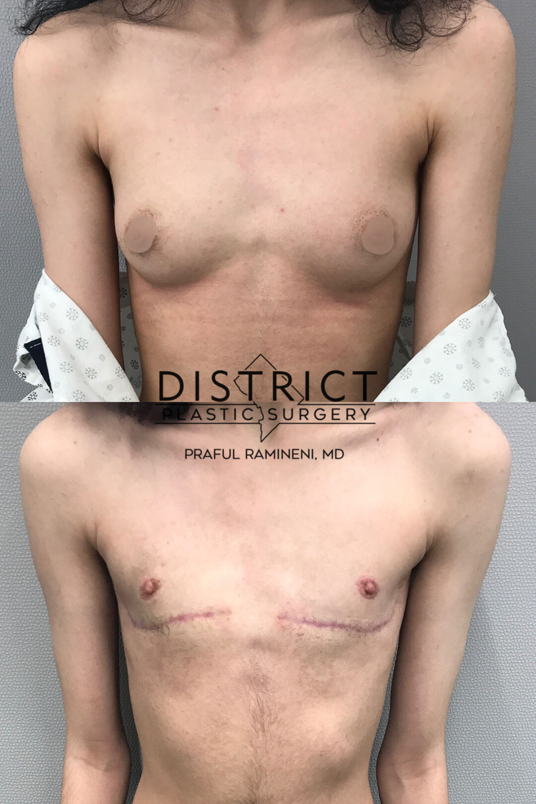 Double Incision Mastectomy Before and After Photo by District Plastic Surgery in Washington, DC