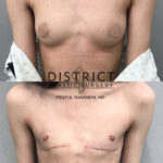 Double Incision Mastectomy Before and After Photo by District Plastic Surgery in Washington, DC