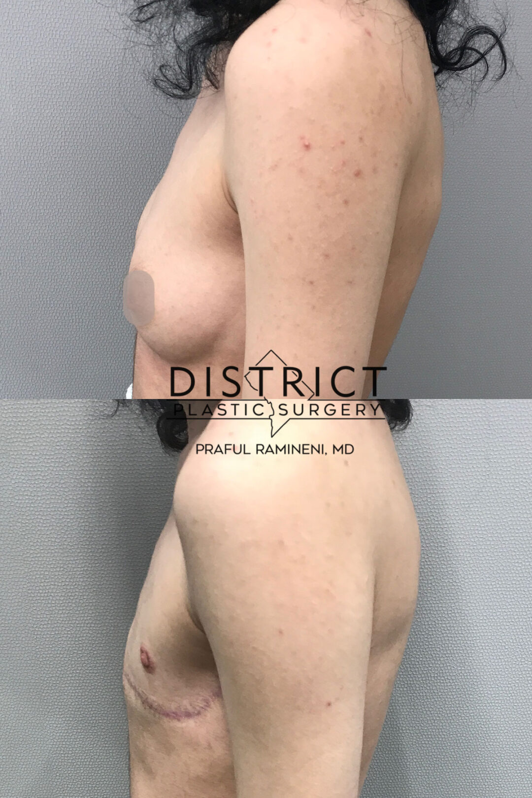 Double Incision Mastectomy Before and After Photo by District Plastic Surgery in Washington, DC