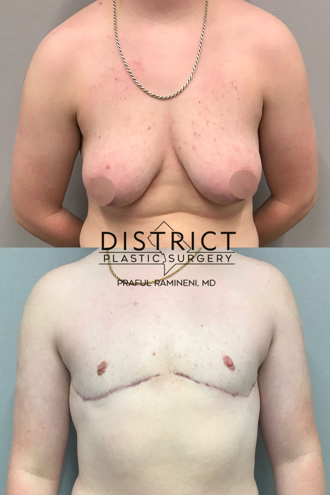 Double Incision Mastectomy Before and After Photo by District Plastic Surgery in Washington, DC