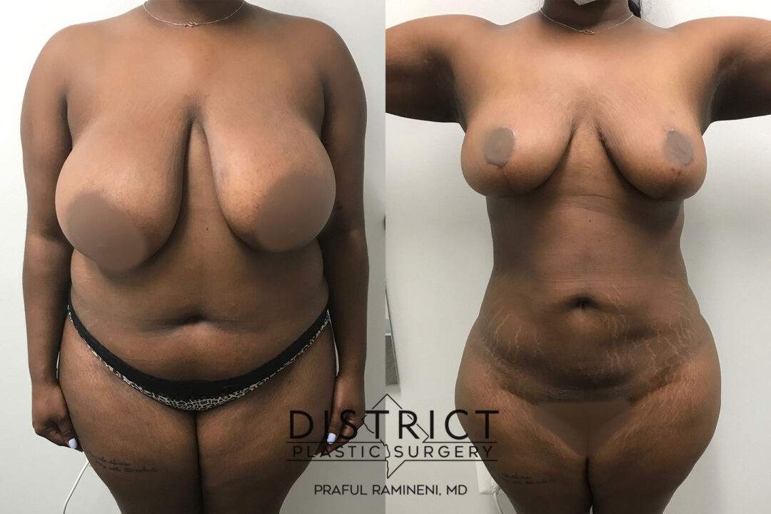 Large Volume Liposuction Before and After Photo by District Plastic Surgery in Washington, DC