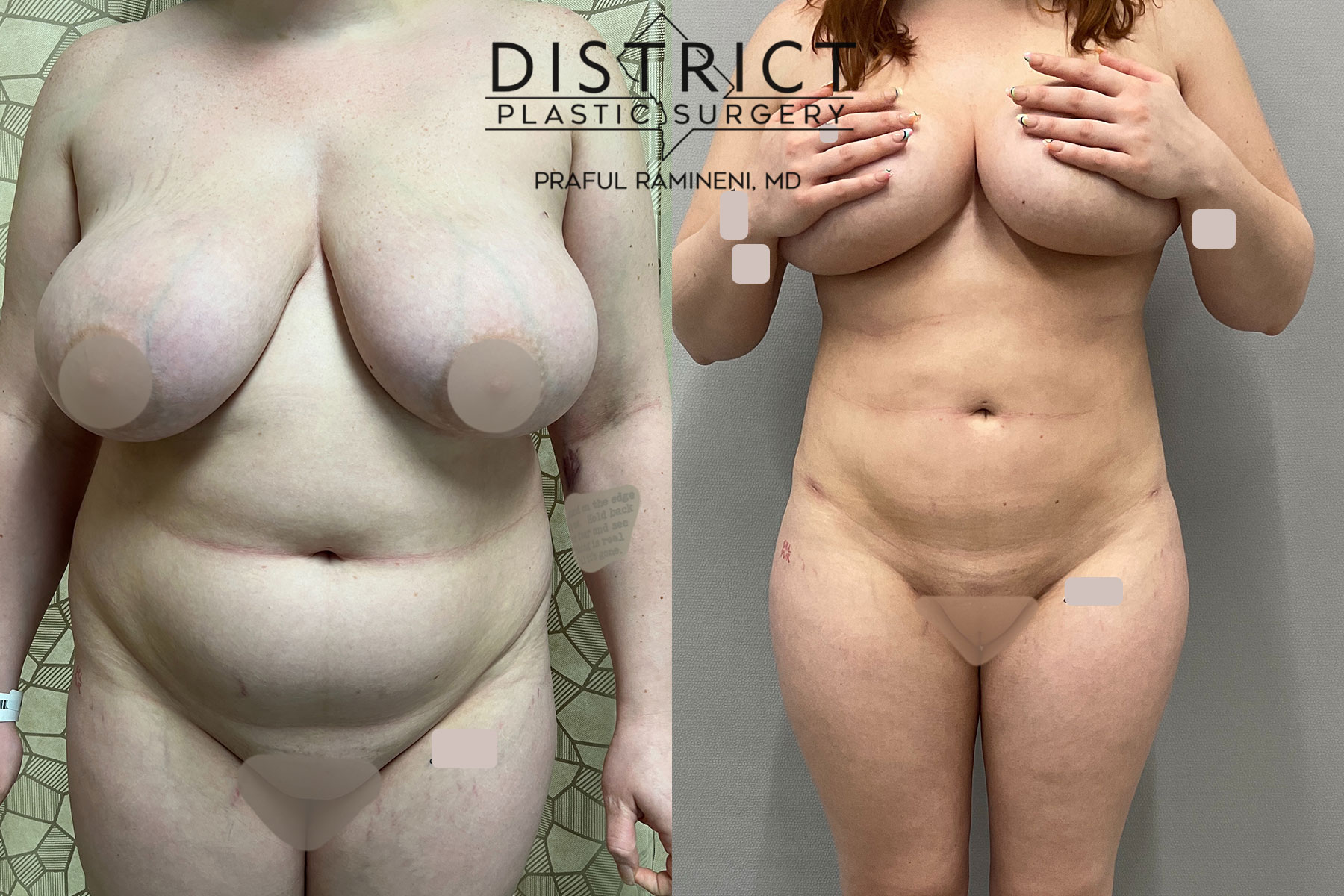 Large Volume Liposuction Before and After Photo by District Plastic Surgery in Washington, DC