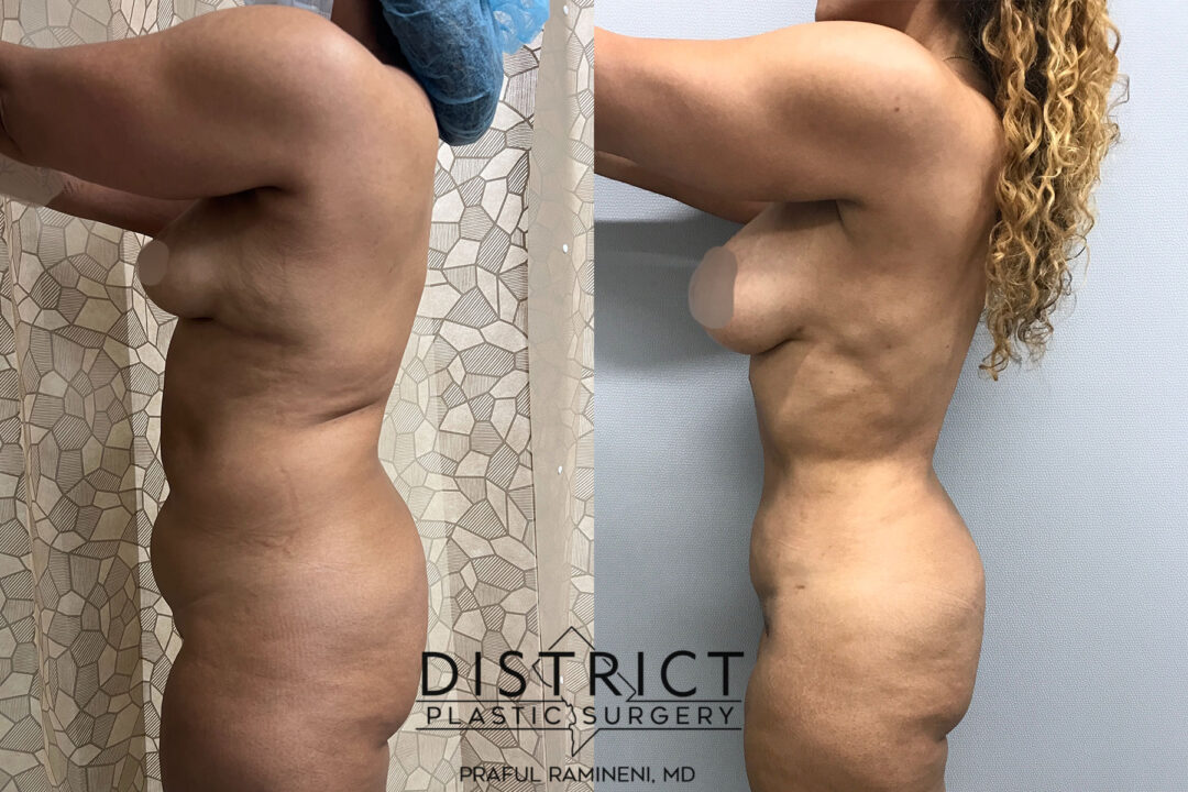 Liposuction Before and After Photo by District Plastic Surgery in Washington, DC