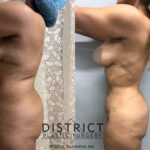 Liposuction Before and After Photo by District Plastic Surgery in Washington, DC