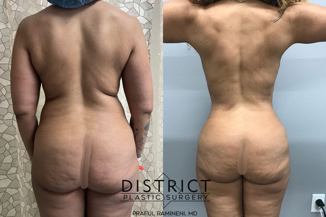 Liposuction Before and After Photo by District Plastic Surgery in Washington, DC