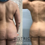 Liposuction Before and After Photo by District Plastic Surgery in Washington, DC