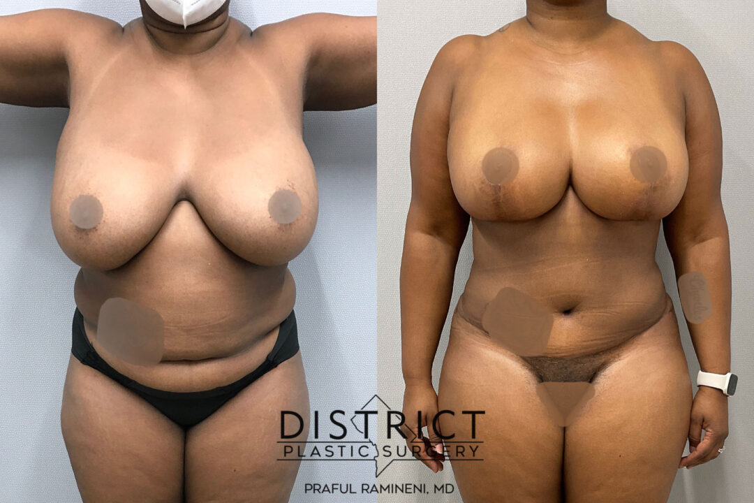 Mommy Makeover Before and After Photo by District Plastic Surgery in Washington, DC.jpeg
