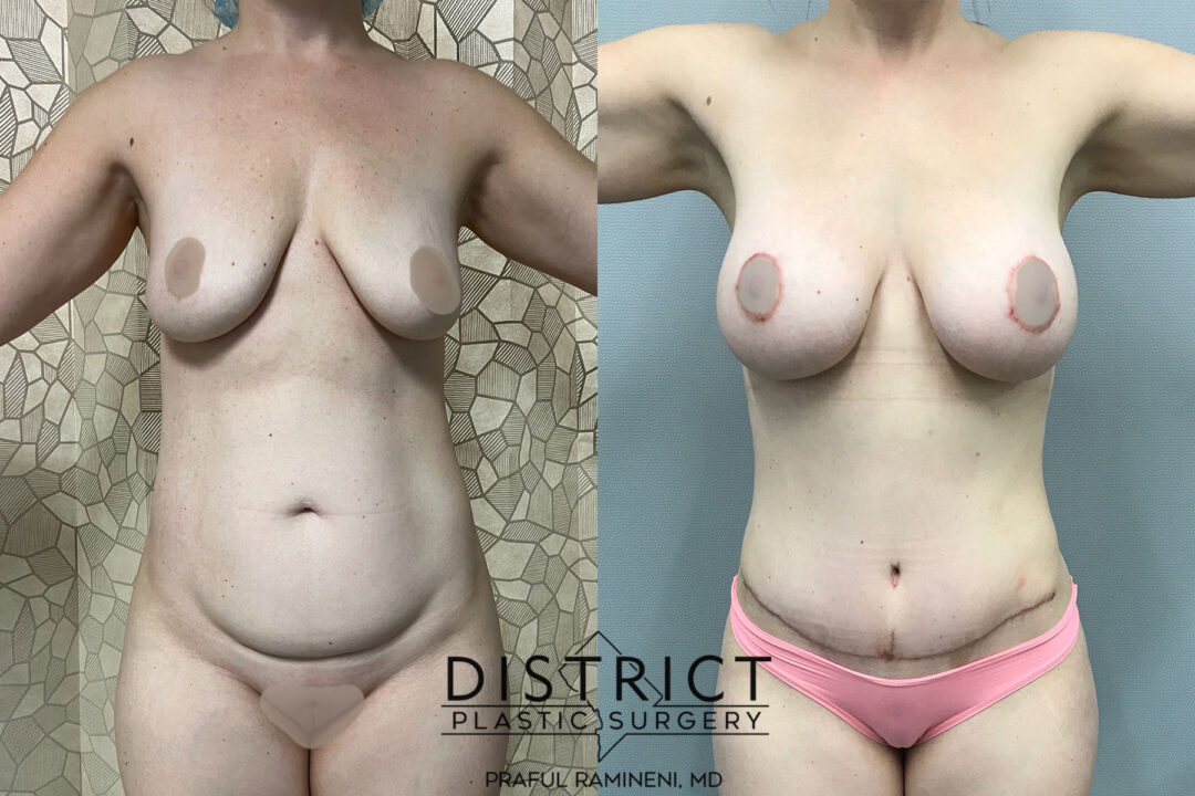 Mommy Makeover Before and After Photo by District Plastic Surgery in Washington, DC.jpeg