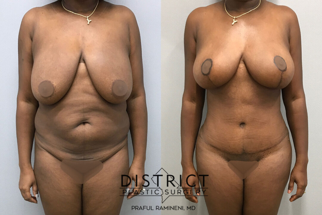 Mommy Makeover Before and After Photo by District Plastic Surgery in Washington, DC.jpeg