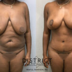 Mommy Makeover Before and After Photo by District Plastic Surgery in Washington, DC.jpeg