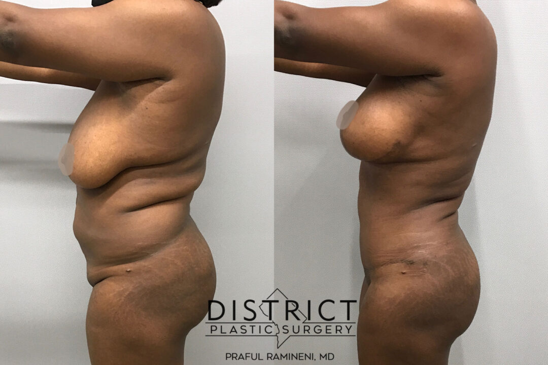 Mommy Makeover Before and After Photo by District Plastic Surgery in Washington, DC.jpeg