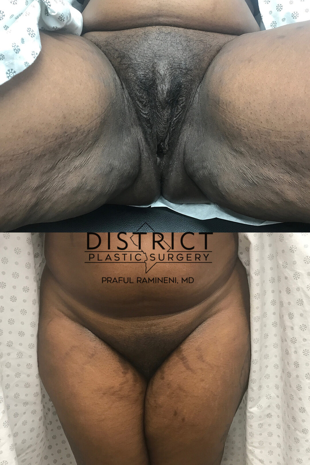 Vaginoplasty Before and After Photo by District Plastic Surgery in Washington, DC.jpeg.jpeg