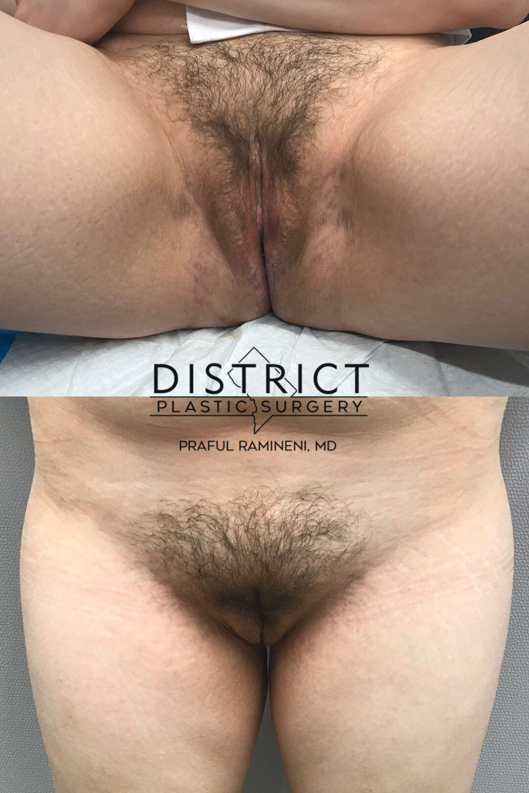 Vaginoplasty Before and After Photo by District Plastic Surgery in Washington, DC.jpeg.jpeg