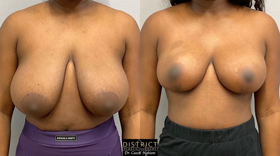 Breast Reduction Before and After Photo by District Plastic Surgery in Washington, DC