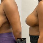 Breast Reduction Before and After Photo by District Plastic Surgery in Washington, DC