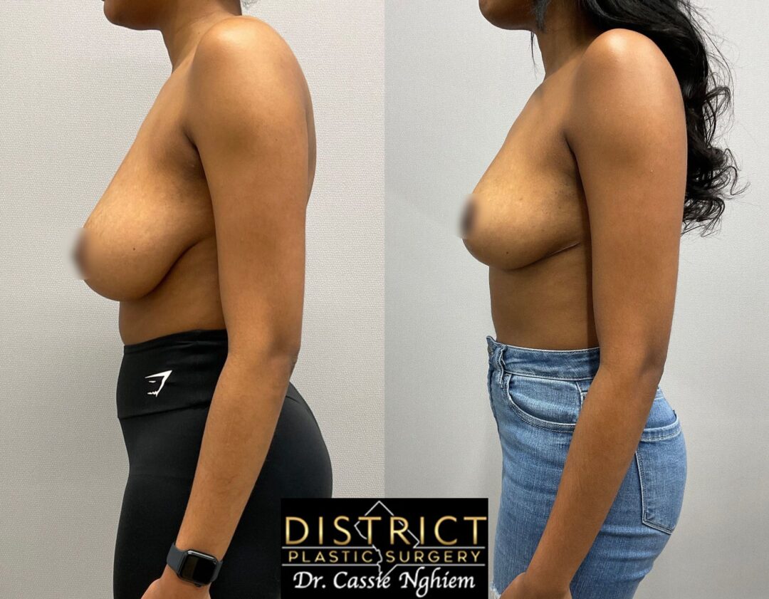 Breast Reduction Before and After Photo by District Plastic Surgery in Washington, DC