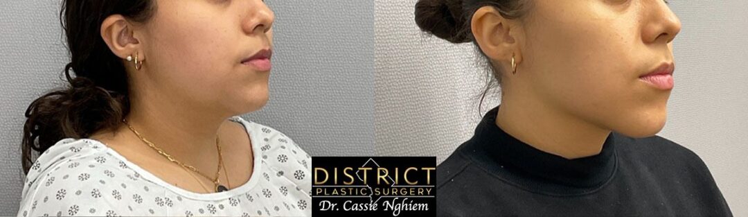 Submental Liposuction Before and After Photo by District Plastic Surgery in Washington, DC