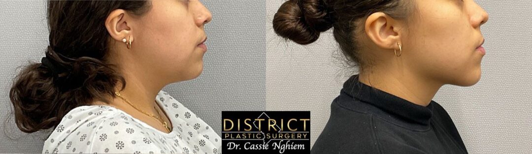 Submental Liposuction Before and After Photo by District Plastic Surgery in Washington, DC