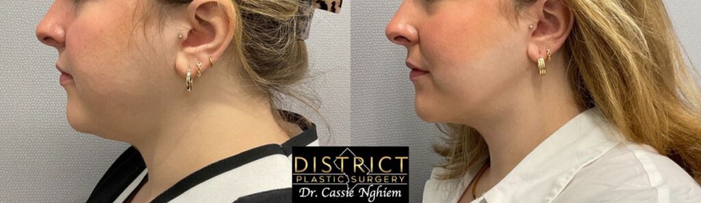 Submental Liposuction Before and After Photo by District Plastic Surgery in Washington, DC Submental Liposuction Before and After Photo by District Plastic Surgery in Washington, DC
