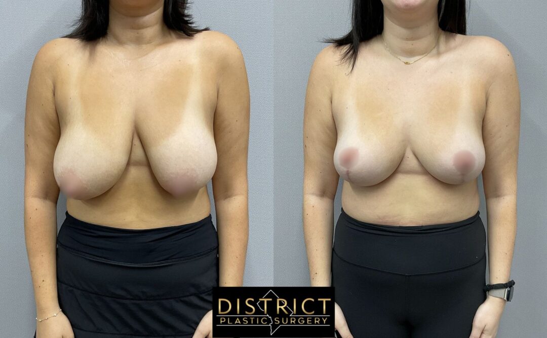Breast Lift Before and After Photo by District Plastic Surgery in Washington, DC