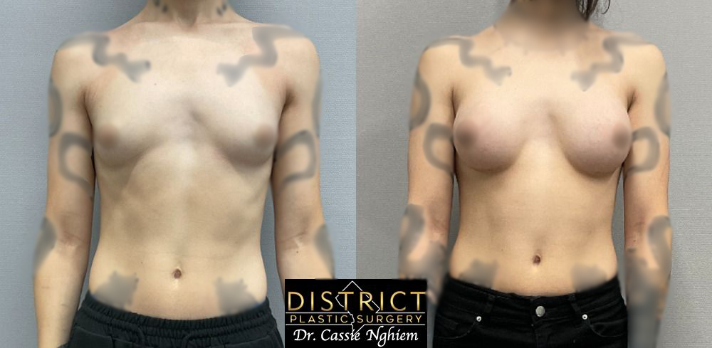 Double Incision Mastectomy Before and After Photo by District Plastic Surgery in Washington, DC