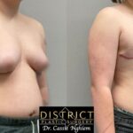 Double Incision Mastectomy Before and After Photo by District Plastic Surgery in Washington, DC