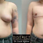 Double Incision Mastectomy Before and After Photo by District Plastic Surgery in Washington, DC