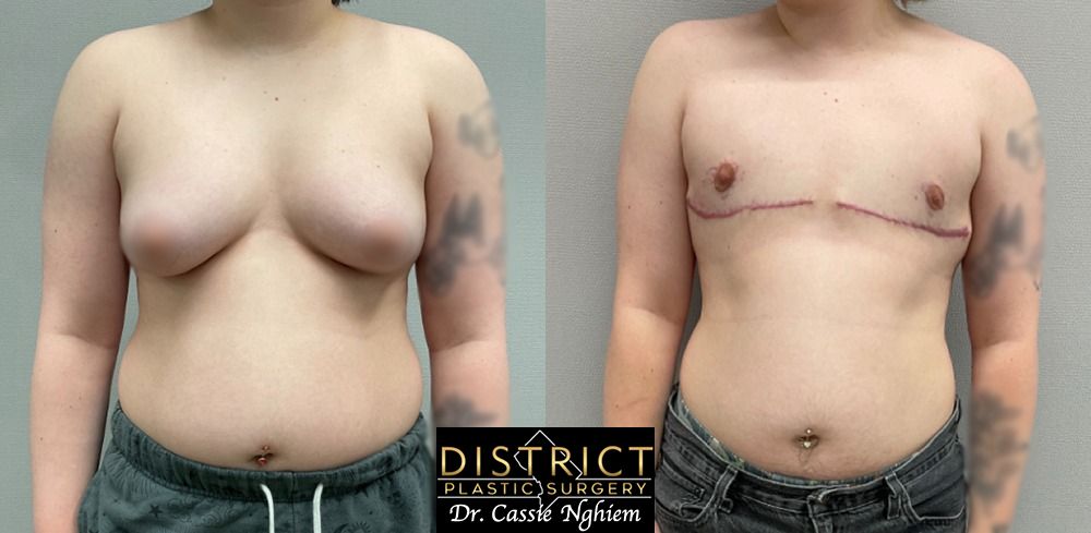 Double Incision Mastectomy Before and After Photo by District Plastic Surgery in Washington, DC