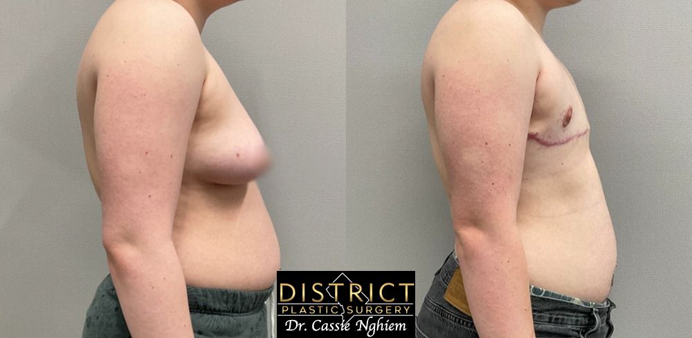 Double Incision Mastectomy Before and After Photo by District Plastic Surgery in Washington, DC