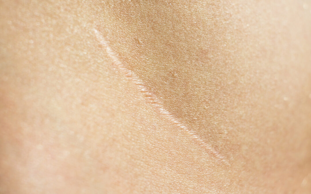Managing Scars After Gender-Affirming Surgery
