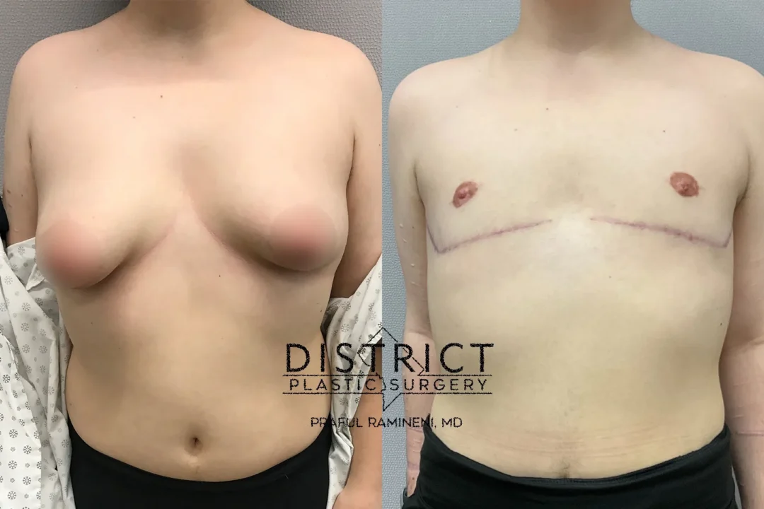 Double Incision Mastectomy Before and After Photo by District Plastic Surgery