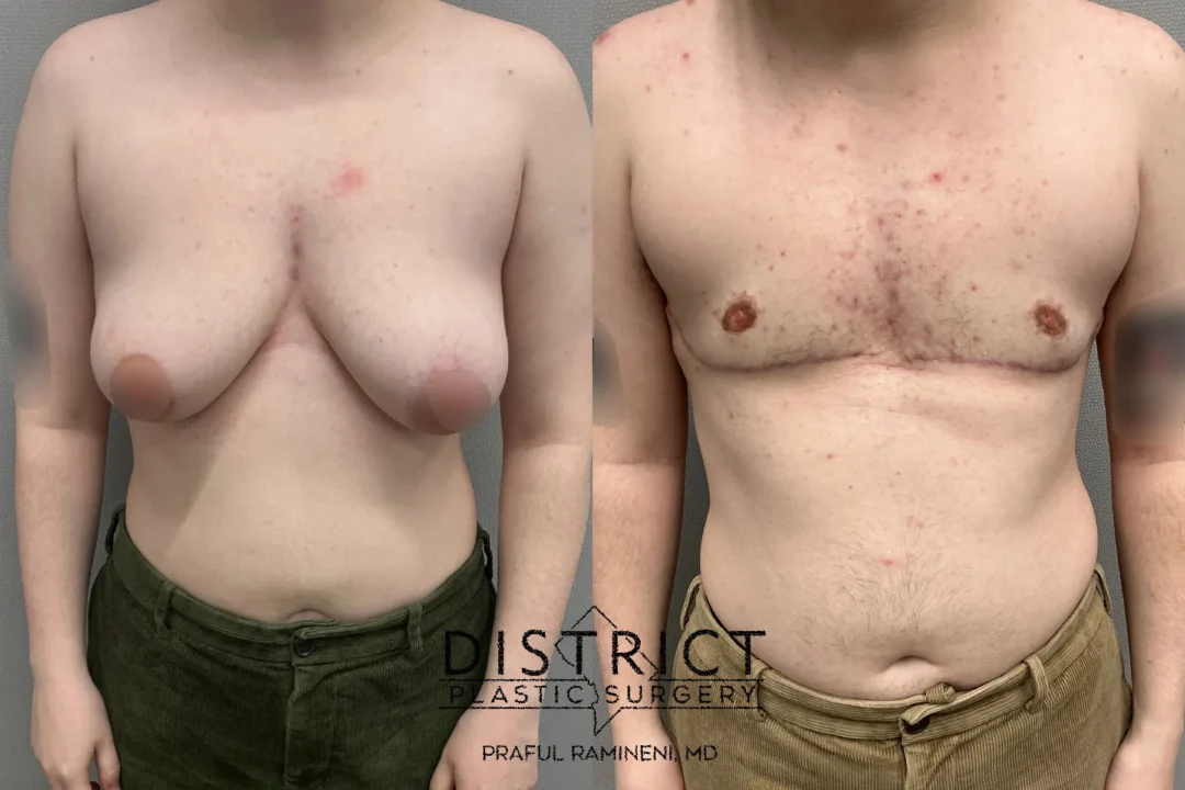 Double Incision Mastectomy Before and After Photo by District Plastic Surgery