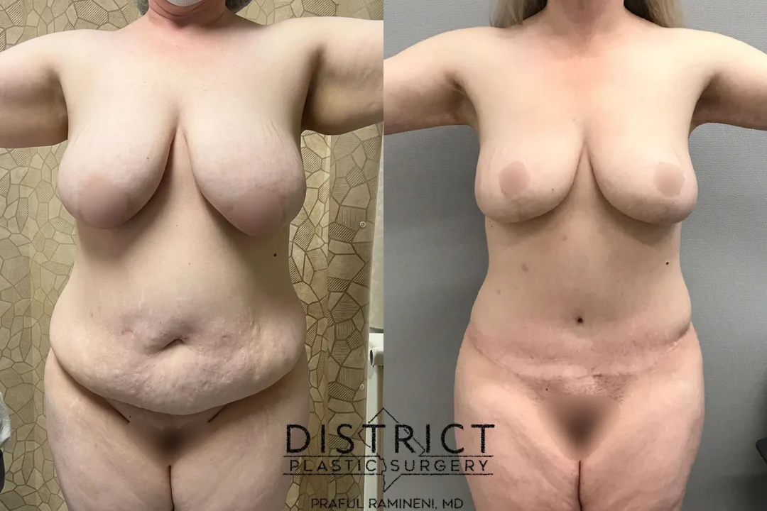 Front View Abdominoplasty Before and After Photo by District Plastic Surgery