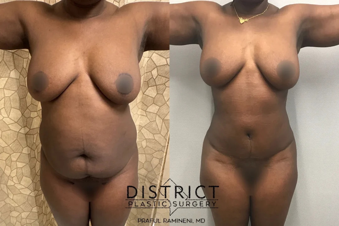 Front View Abdominoplasty Before and After Photo by District Plastic Surgery